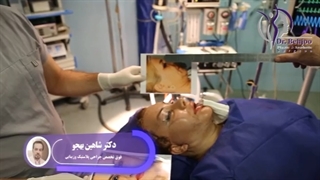 لیفت کامل صورت و پیشانی