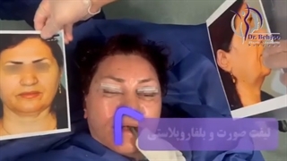 لیفت صورت و بلفاروپلاستی