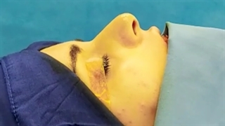 قبل و بعد از جراحی بینی زیباجوی عزیزم