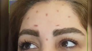 تزریق بوتاکس به پیشانی کاشت ابرو