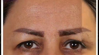 لیفت شقیقه همراه با جراحی پلک