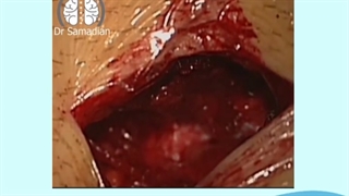 عمل جراحی میکروسکوپی دیسک کمری