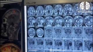 عمل جراحی گلیوم بسیار بزرگ تمپورال و اینسولای چپ