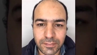 معجزه کاشت مو ایران