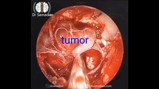عمل جراحی آدنوم هیپوفیز