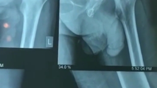 تعویض مفصل لگن