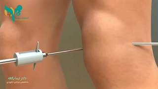 ارتروسکوپی زانو