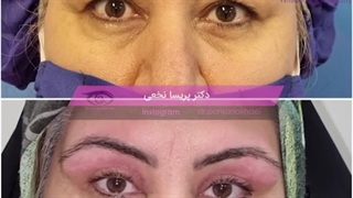 بلفاروپلاستی پلک‌های فوقانی