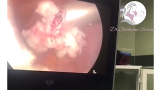 لاپاراسکوپی میوم 8 سانت