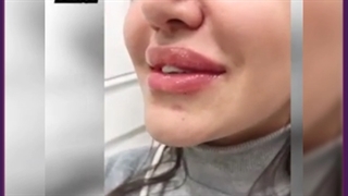عوارض احتمالی تزریق ژل در نواحی مختلف صورت و بدن هایفوتراپی