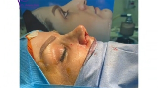 عمل جراحی زیبایی بینی