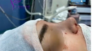 فیلم جراحی زیبایی بینی