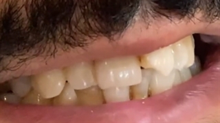 ۸ واحد لمینت سرامیکی ایمکس