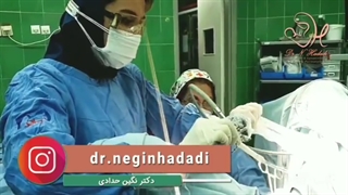 فیلم خارج کردن رحم از بدن