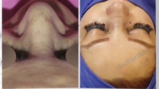 جراحی بینی با انحراف و افتادگی شدید | دکتر امید ابراهیمی