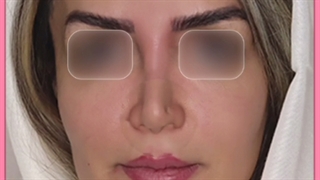 آشنایی با انواع روش های لیفت بینی بدون جراحی/ژل و نخ