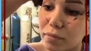 هزینه انواع روش های لیفت شقیقه