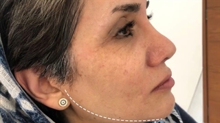 فرم دهی و زاویه سازی صورت با تزریق چربی