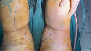 فیلم واقعی لیپوماتیک ساق ران