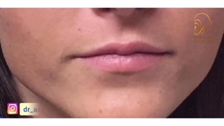 فیلم نمونه کار تزریق ژل به لب قبل و بعد از عمل