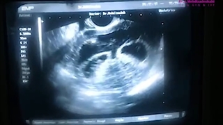 IVF موفق 3 قلویی!