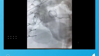 جراحی اورژانسی نارسایی حاد و شدید دریچه آئورت