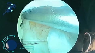 پارگی باکت هندل منیسک داخلی| دکتر شیروانی بختیاری