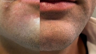 اصلاح فرو رفتگی چانه برداشتن توده