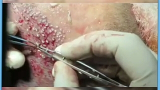 آشنایی با جدیدترین و مدرن ترین روش های کاشت مو در ایران