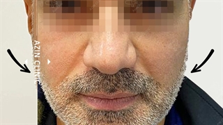 زاویه سازی فک