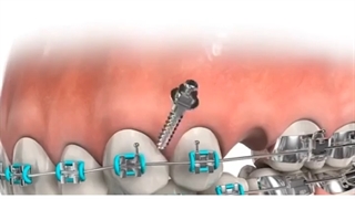 مینی اسکرو چیست ؟ mini screw | دکتر نگار حدادی جرمگیری