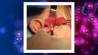 جراحی تومور پاروتید با کمک آندوسکوپ