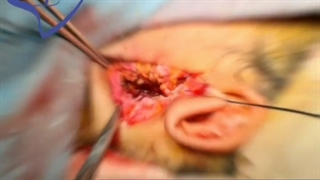 فیلم تومور لوب عمقی