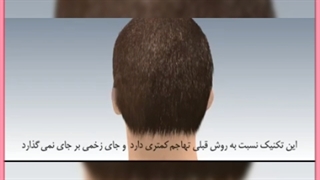 مراحل،مزایا و هزینه کاشت مو به روش super fue
