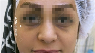 تزریق چربی صورت