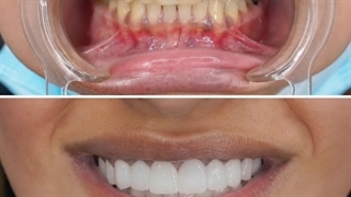 فیلم واقعی لمینت دندان لیفت صورت