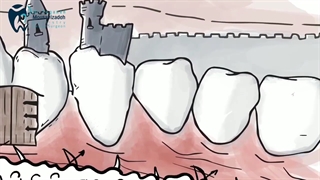 پوسیدگی دندان