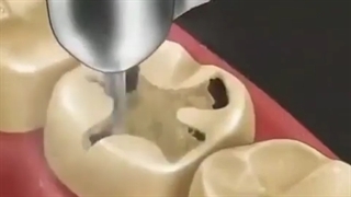 پر کردن دندان