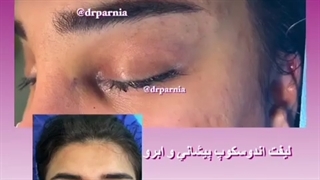 لیفت آندوسکوپ پیشانی