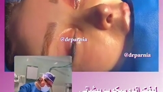 لیفت آندوسکوپ پیشانی