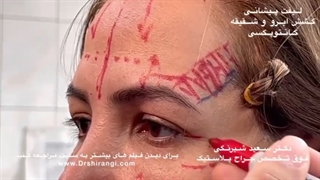 (Canthopexy ) لیفت پیشانی - کشش ابرو و شقیقه کانتوپکسی