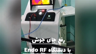 رفع جای جوش ( اسکار آکنه) با دستگاه Endo RF