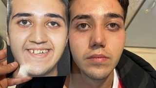 رفع قوز بینی مردانه