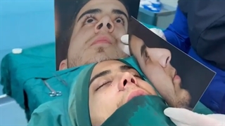 عمل زیبایی بینی مردانه