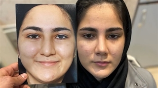 فیلم جراحی بینی استخوانی