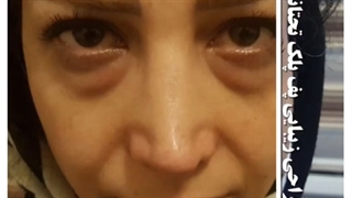 فیلم جراحی زیبایی پلک تحتانی