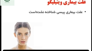 درمان ویتیلیگو کشف شد و توضیحات این بیماری البهاق پیسی برص