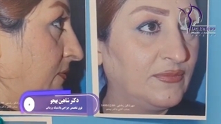 جراحی بینی نیمه فانتزی