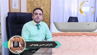 درمان قطعی جای جوش و آکنه با میکرونیدلینگ