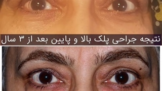 نتیجه ی جراحی پلک بالا و پایین بعد از سه سال